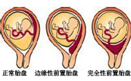 前置胎盤分哪幾種？有什么癥狀？